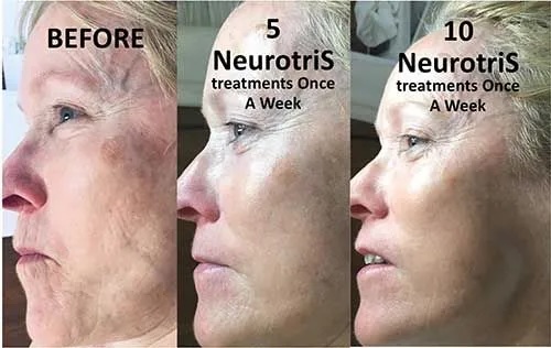 3 images showing a before and after from Neutoris treatment. Before, 5 treatments for 2nd image, and 10 treatments after on right image.